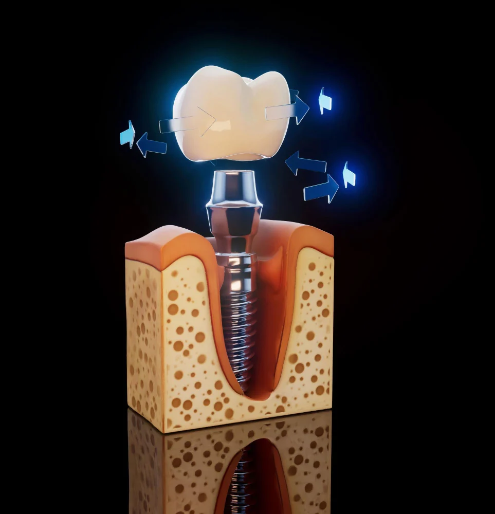 dental implants